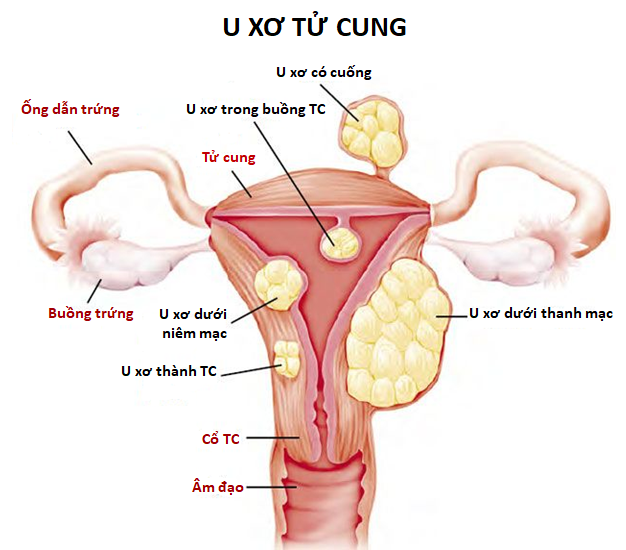2022 07 Uterine fibroids(1)